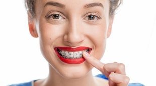 Cómo practicar sexo oral si tienes brackets